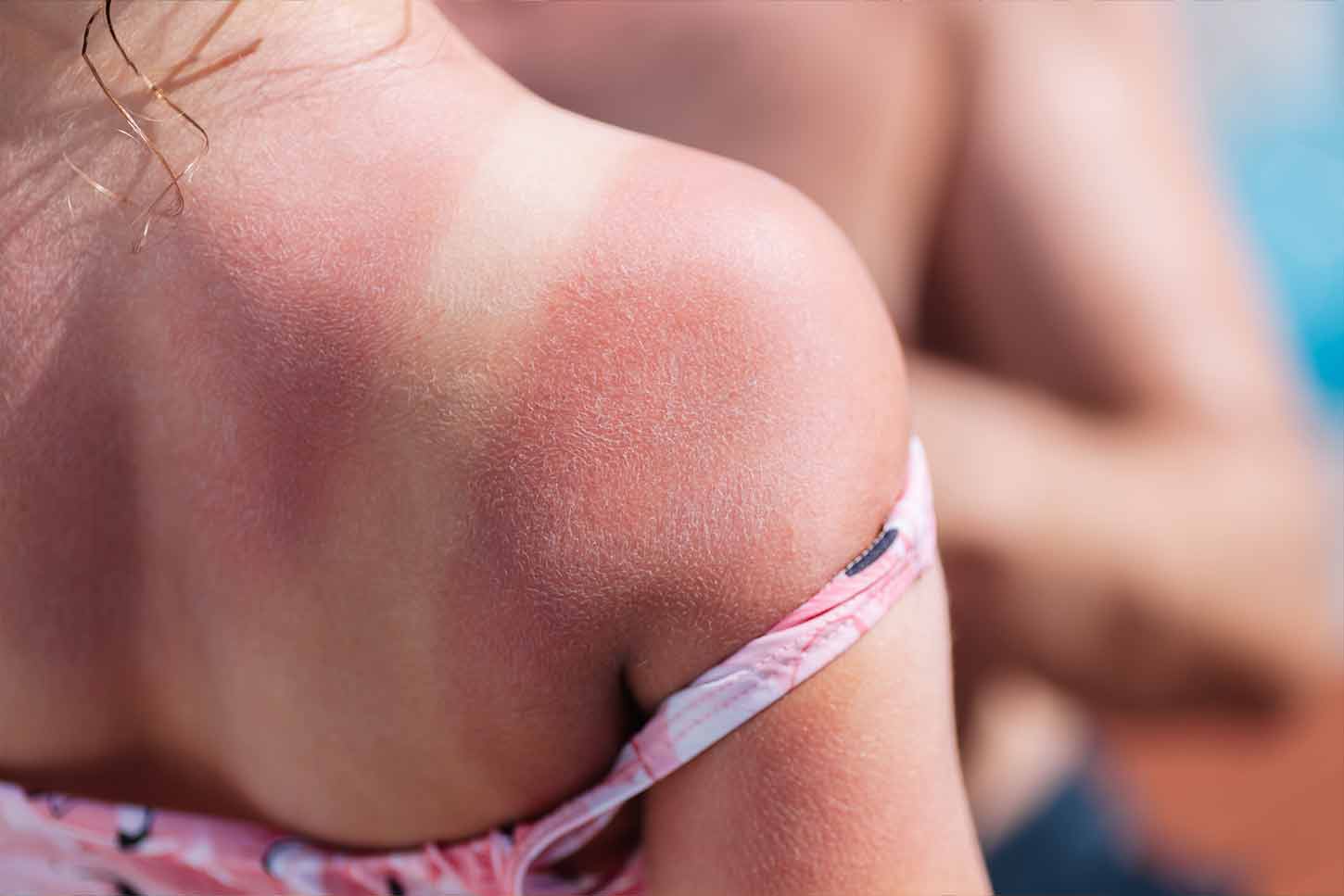 hautkrebs-durch-sonnenbrand-einfach-erklärt
