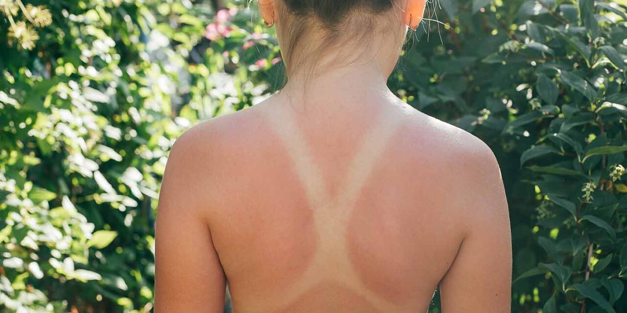 Hautkrebs durch Sonnenbrand – Risiko, Prävention & Schutzmaßnahmen