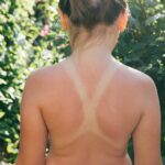 Hautkrebs durch Sonnenbrand – Risiko, Prävention & Schutzmaßnahmen
