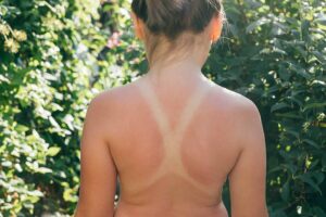 Deutlicher Sonnenbrand durch unzureichenden UV-Schutz – Gefahr von Hautkrebs