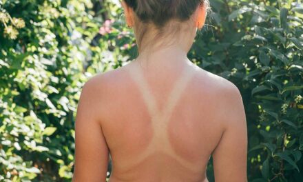 Hautkrebs durch Sonnenbrand – Risiko, Prävention & Schutzmaßnahmen